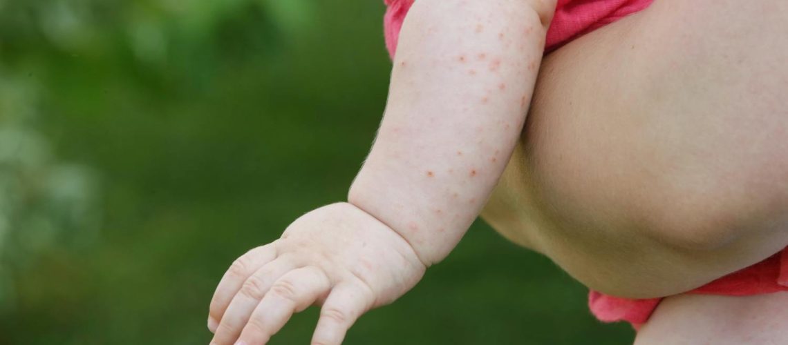 Boutons de chaleur chez bébé : comment les reconnaître ? Quels traitements ? Boutons de chaleur chez bébé : comment les reconnaître ? Quels traitements ?