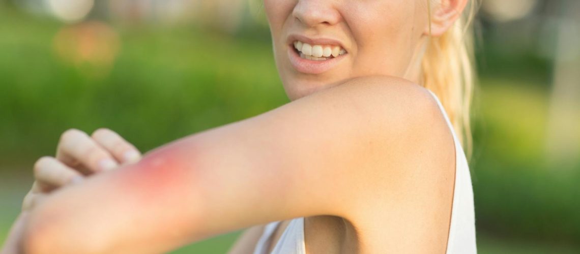 Quelles piqûres d’insecte se manifestent par des plaques rouges ? Quelles piqûres d'insecte se manifestent par des plaques rouges ?